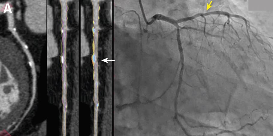 CLARIFY2 - discordant case example